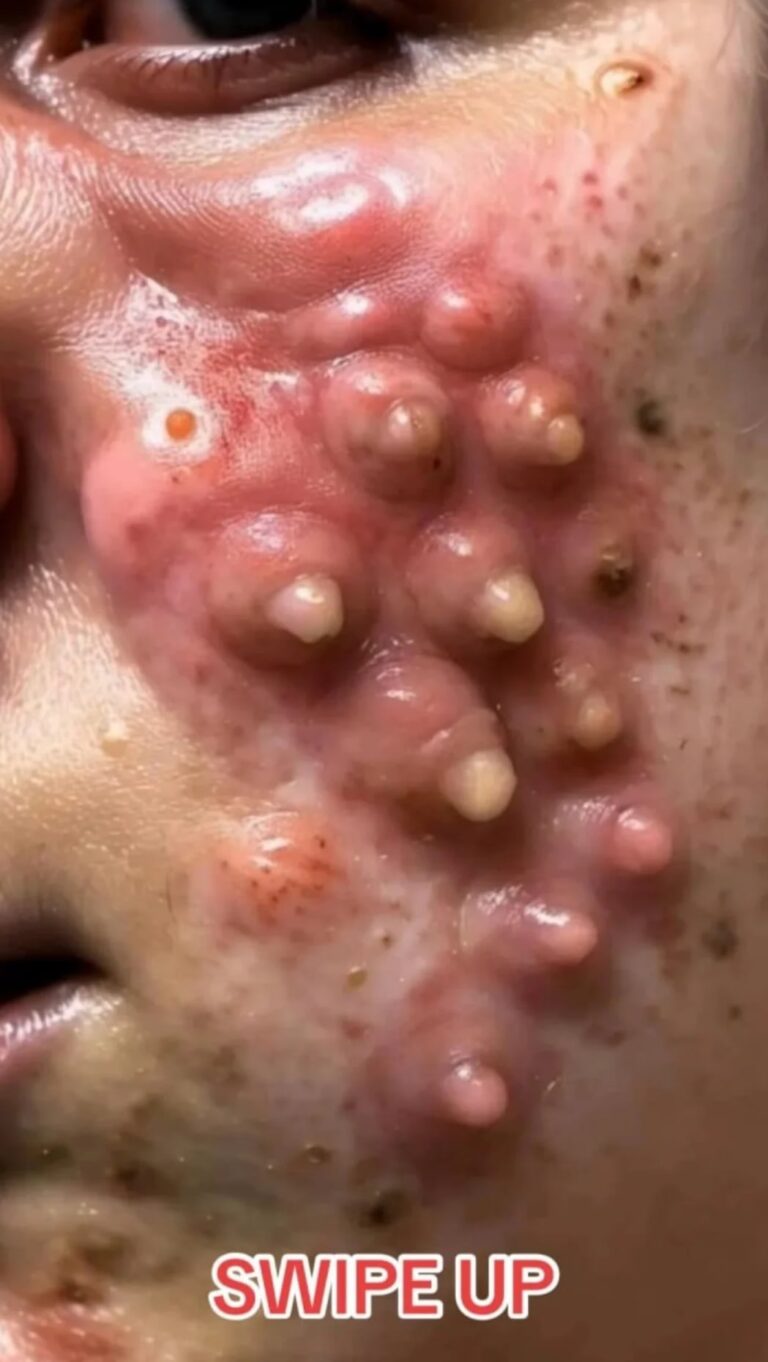 The Patient Fans Still Talk About Years After Dr. Pimple Popper Treated Him